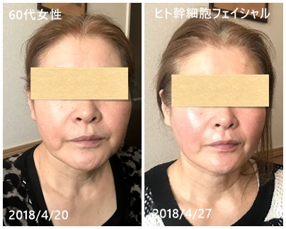 ヒト幹細胞キャンペーンのお客様のビフォーアフター