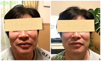 ただいま小顔メニュー準備中です♪