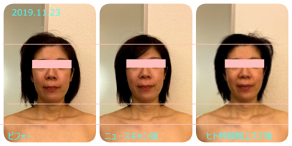 免疫アップは美しさと健康の証。どうしたらアップする！？