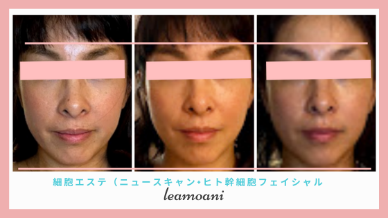 細胞エステーリフトアップコース
