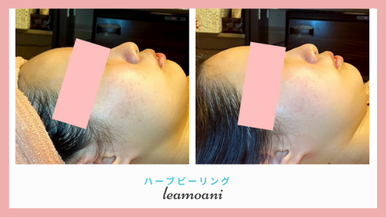 ニキビ肌も強く健康なお肌に！