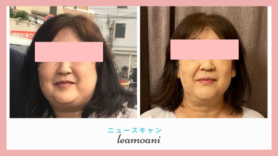 ムーンフェイスも体重もスッキリ！